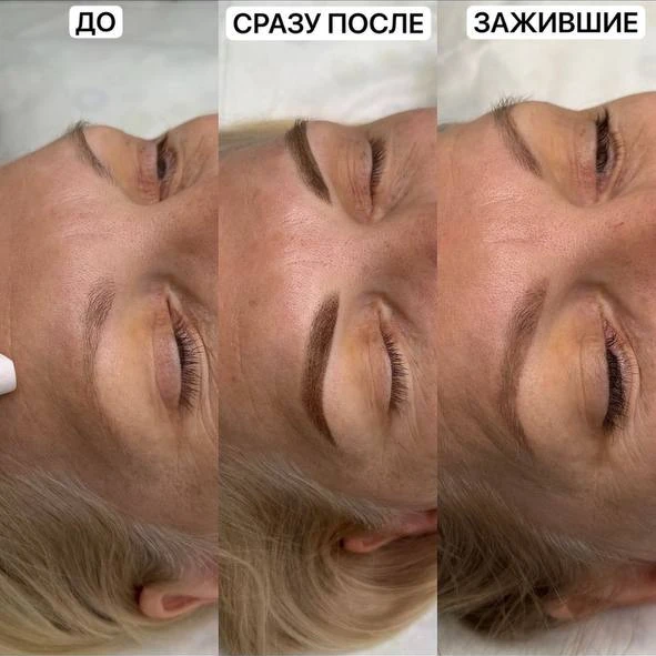 Брови: до, сразу после и после заживления